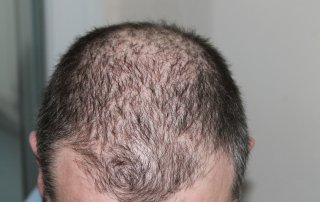 Contratar un tratamiento de mesoterapia capilar con finasteride en CIMED detiene la caída y reactiva el nacimiento y crecimiento de nuevo cabello.